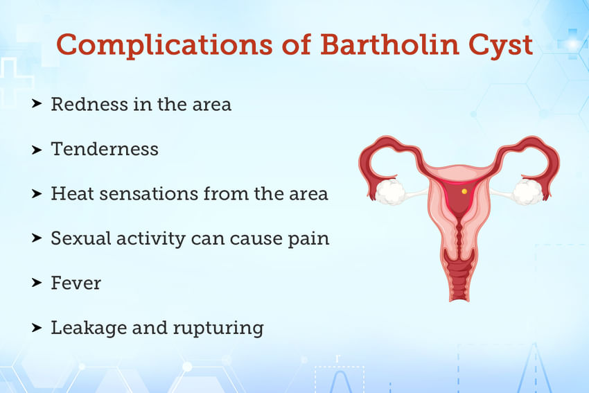 Bartholin S Cyst And Abscess Causes Symptoms Treatment Hot Sex Picture